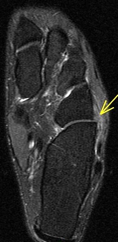 Figure 5 for case Sinus tarsi ligament sprains
